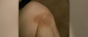 Blood clot in calf symptoms, causes and treatment