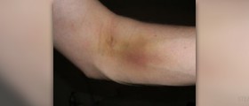 Blood donation side effects