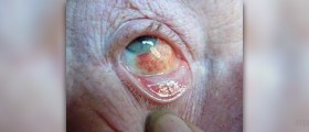 Bloodshot eyes facts