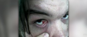 Bloodshot eyes treatment
