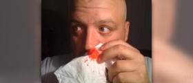 Bloody nose causes