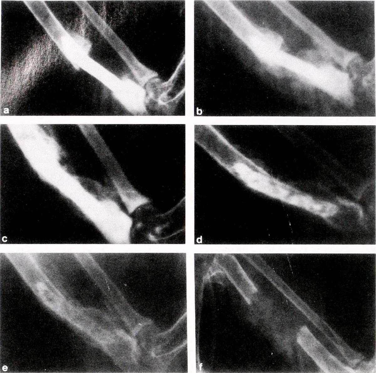 brittle-bone-disease-symptoms-general-center-steadyhealth