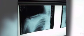 Bone healing herb