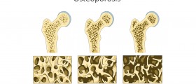 Osteoporosis: The Hidden Disease That Breaks Nine Million Bones A Year