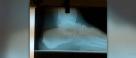 Bone spur symptoms