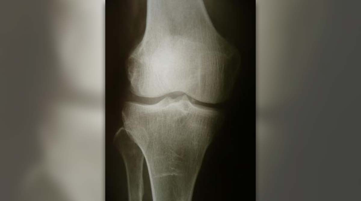 Bone spurs in knee | General center | SteadyHealth.com