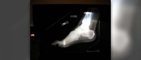 Bone spurs treated at home