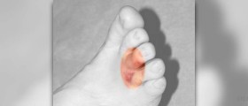Bottom foot pain