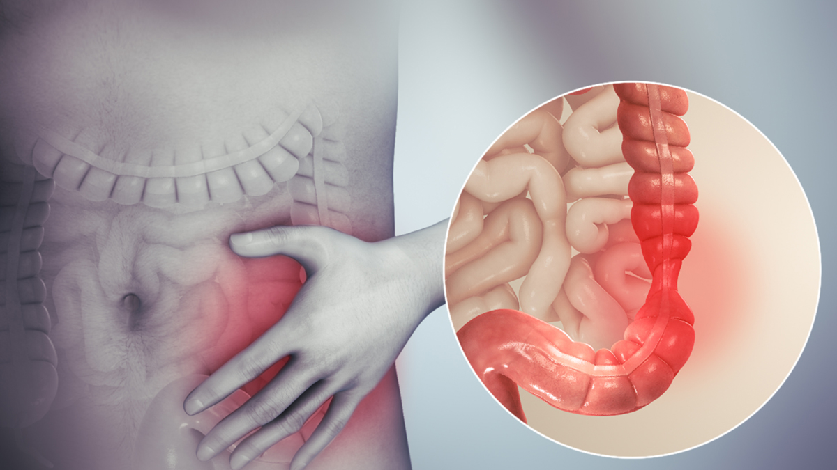 What is irritable bowel syndrome General center