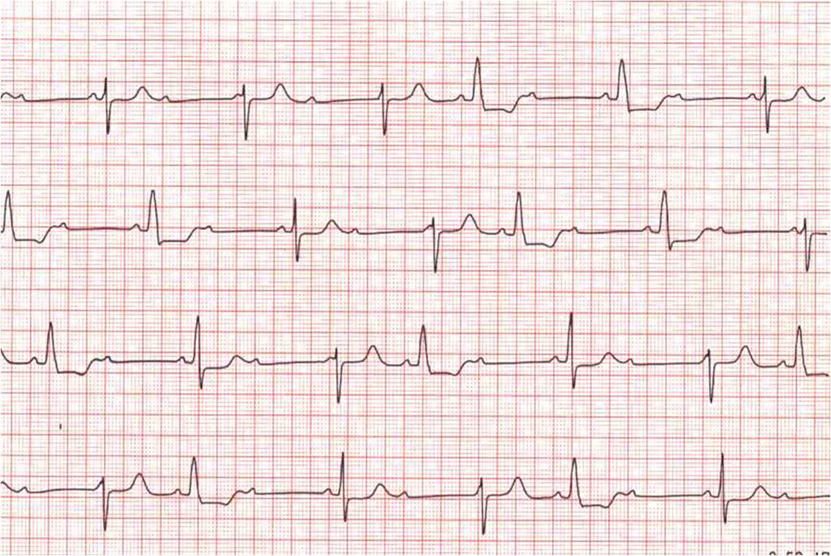 causes-of-bradycardia-general-center-steadyhealth