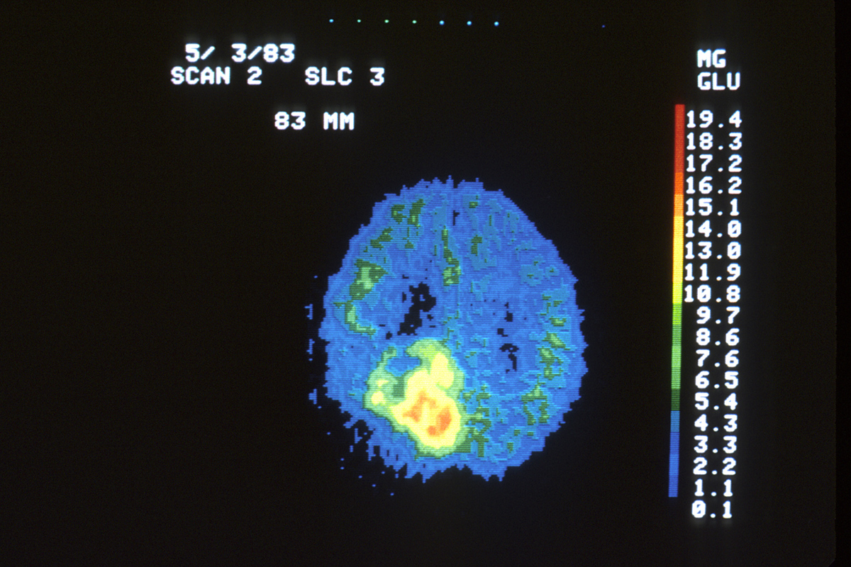 brain cancer stage 2 survival rate