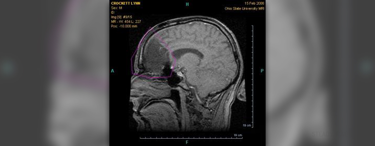 Brain tumor survival rate General center