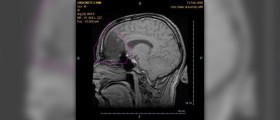 Brain tumor survival rate