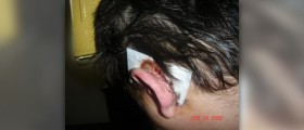 Brain tumors surgery