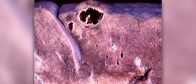 Branchial cleft cyst