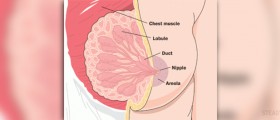 Breast duct ectasia