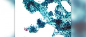 Breast pain in one breast