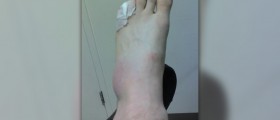 Broken pinky toe