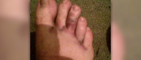 Broken toe healing time