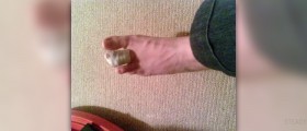 Broken toe - what to do