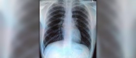 Bruised ribs from coughing