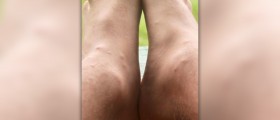 Bug bites that cause blisters