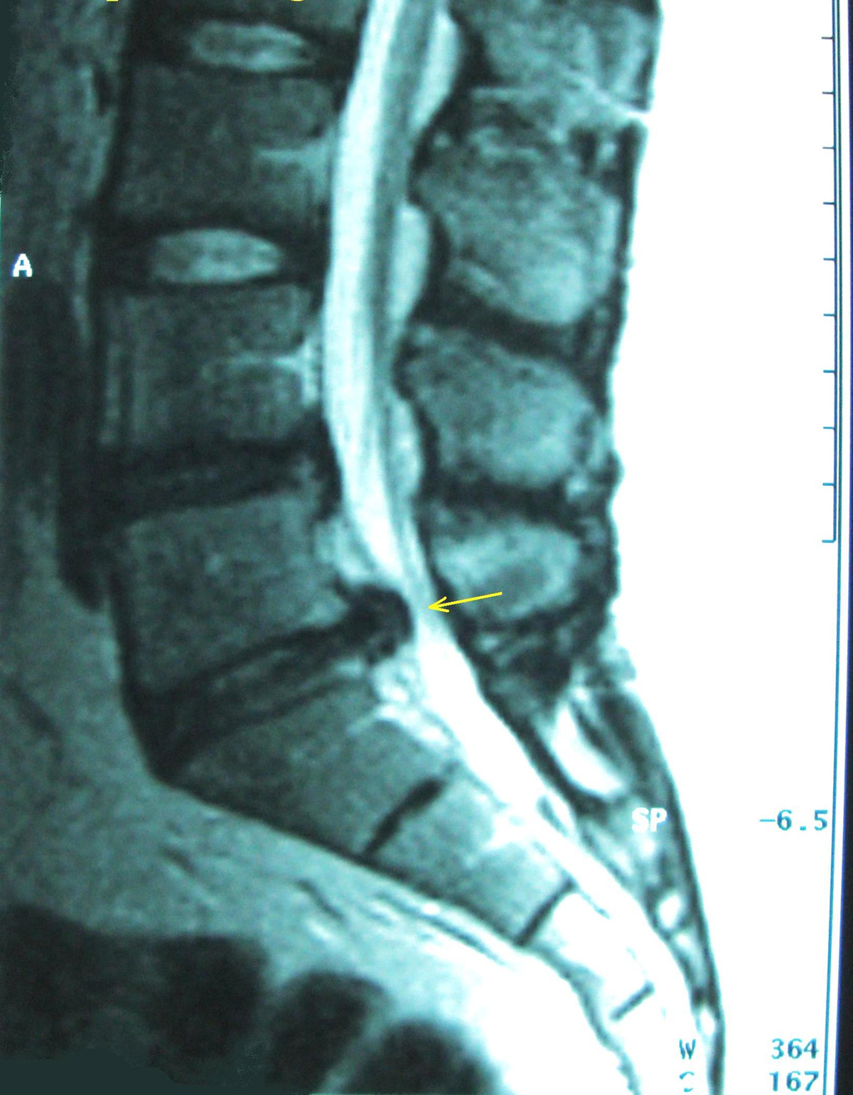 Bulging disc pain | General center | SteadyHealth.com