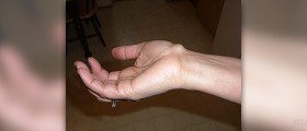 Bumps on skin that don't itch
