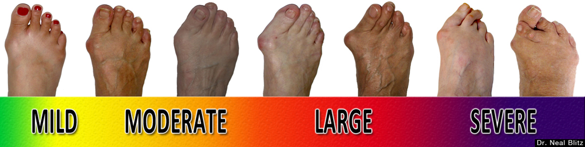 how-to-treat-a-tailor-s-bunion-general-center-steadyhealth