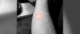 Burn scar treatment