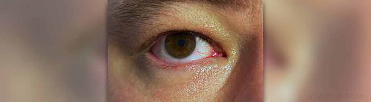 burning-and-itching-eyes-eye-disorders-and-diseases-articles-body-health-conditions-center