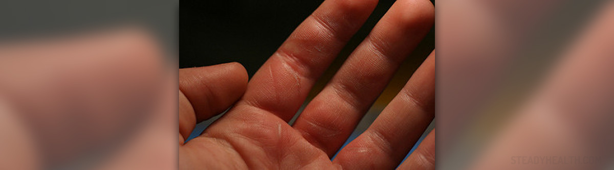 burning-hands-sensation-musculoskeletal-issues-articles-body