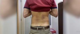 Burning lower back pain
