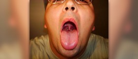 Burning sore throat