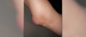 Bursitis exercises