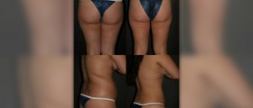 Buttock enhancement - why women go for it?