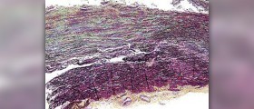 Caffeine cystic acne