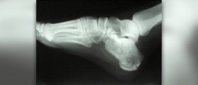 Calcaneal stress fractures
