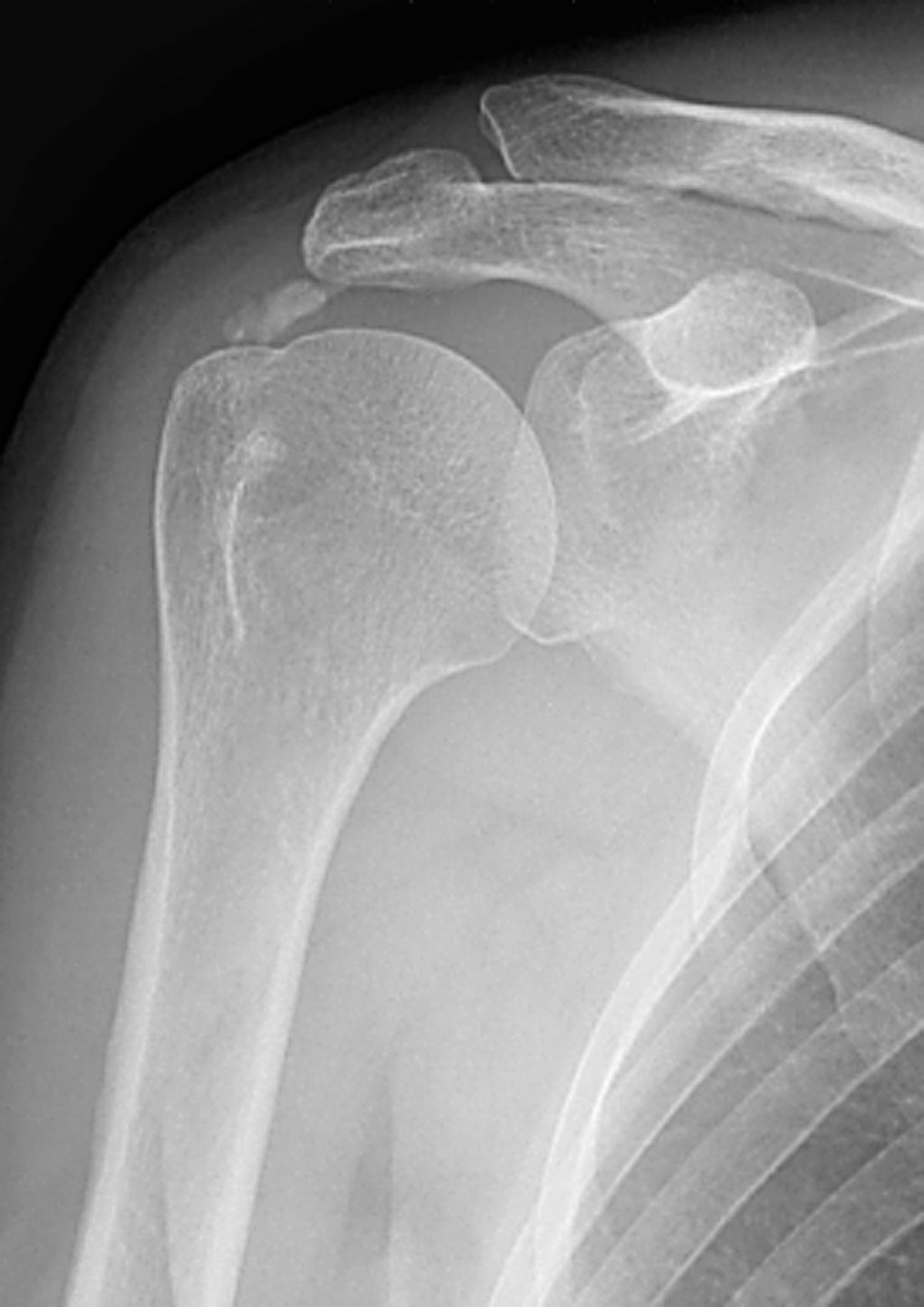 Calcium build up in shoulder | Musculoskeletal Issues articles | Body ...