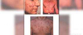 Camphor oil for acne