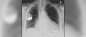 Can iPods interfere with pacemakers?