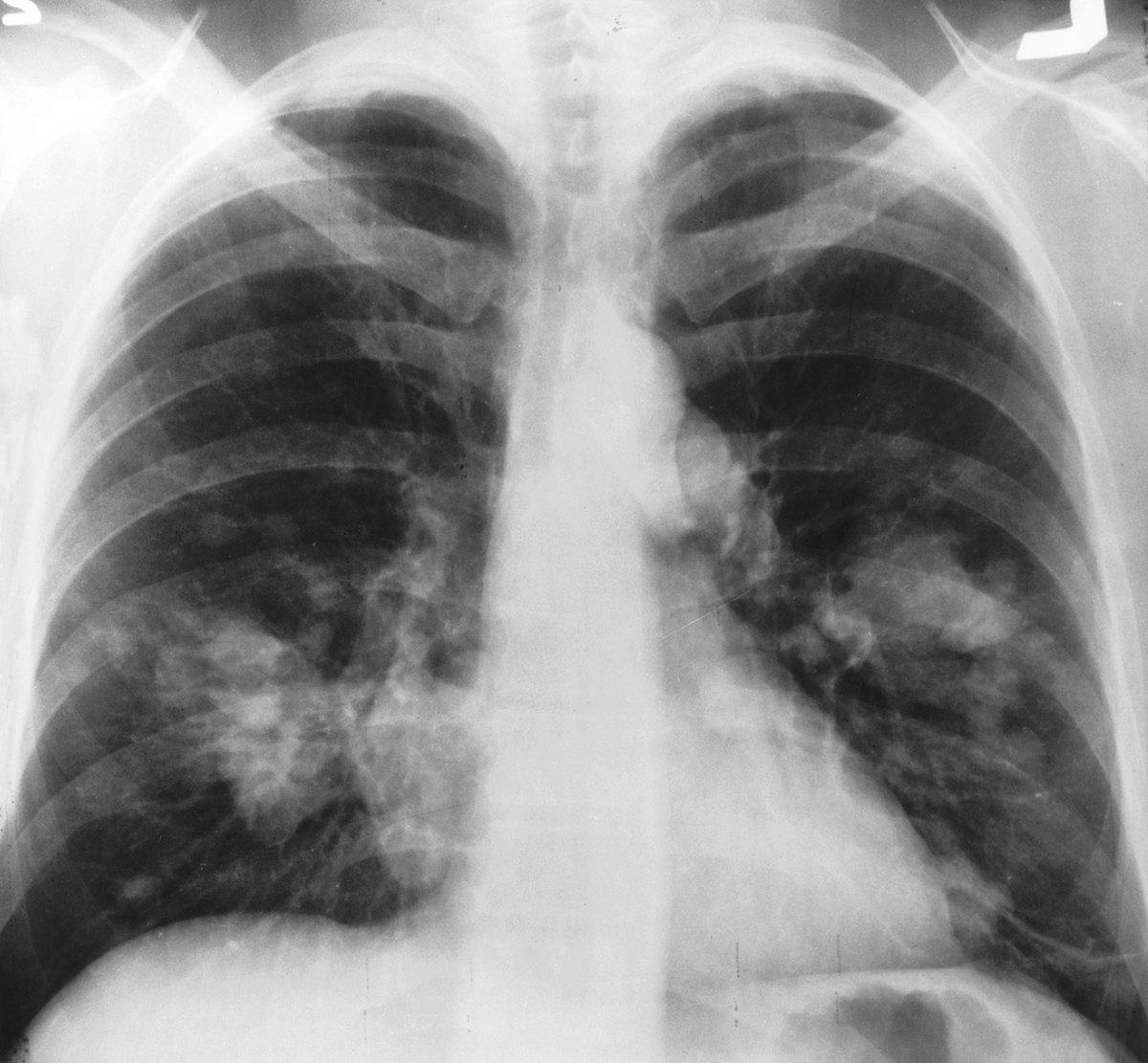 Small cell lung cancer staging | General center | SteadyHealth.com