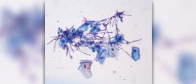 Candida symptoms in men