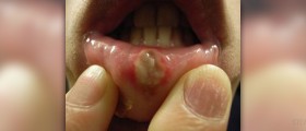 Canker sore on lip