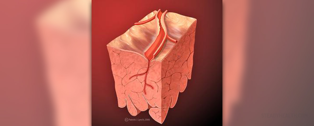 What Is Mild To Moderate Carotid Artery Blockage