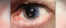 Cataract surgery cost
