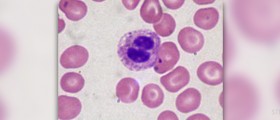 Cause, symptoms and treatment for myelodysplastic syndromes