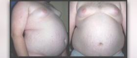 Causes and cures for obesity epidemic