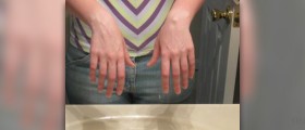 Causes and treatment for ganglion cysts