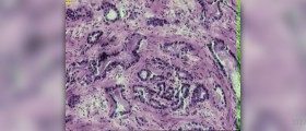 Causes and treatment of prostate cancer